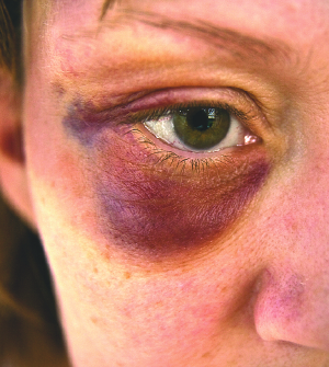 Why do bruises go purple?