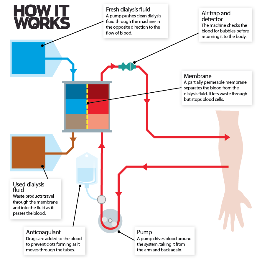 cleaning-the-blood-how-does-dialysis-work-how-it-works