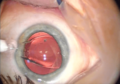 4. Once it has fully unfolded, the surgeon tucks the edges into tissue behind the iris.