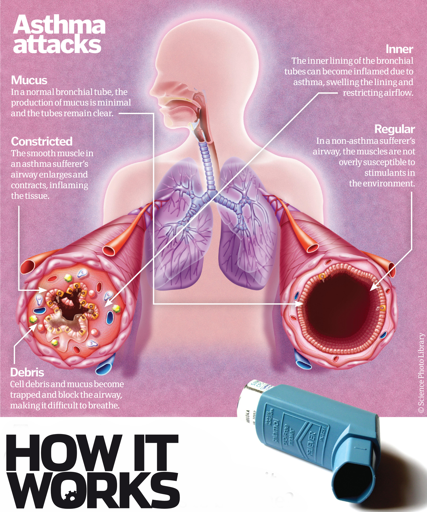 asthma description essay